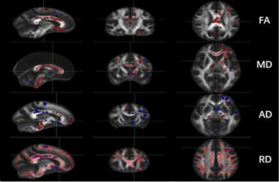 White Matter Characteristics of Cognitive Impairment in Tap-Test Positive Idiopathic Normal Pressure Hydrocephalus: A Diffusion Tensor Tract-Based Spatial Study